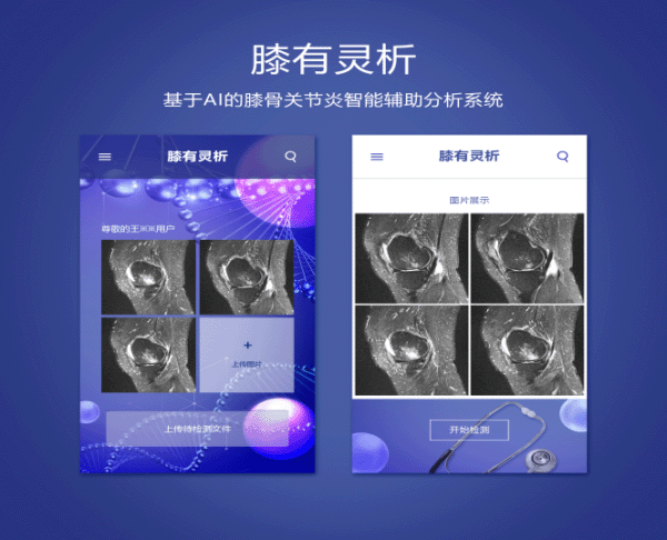 “膝”有灵“析”，膝骨关节炎智能辅助分析新突破(图1)